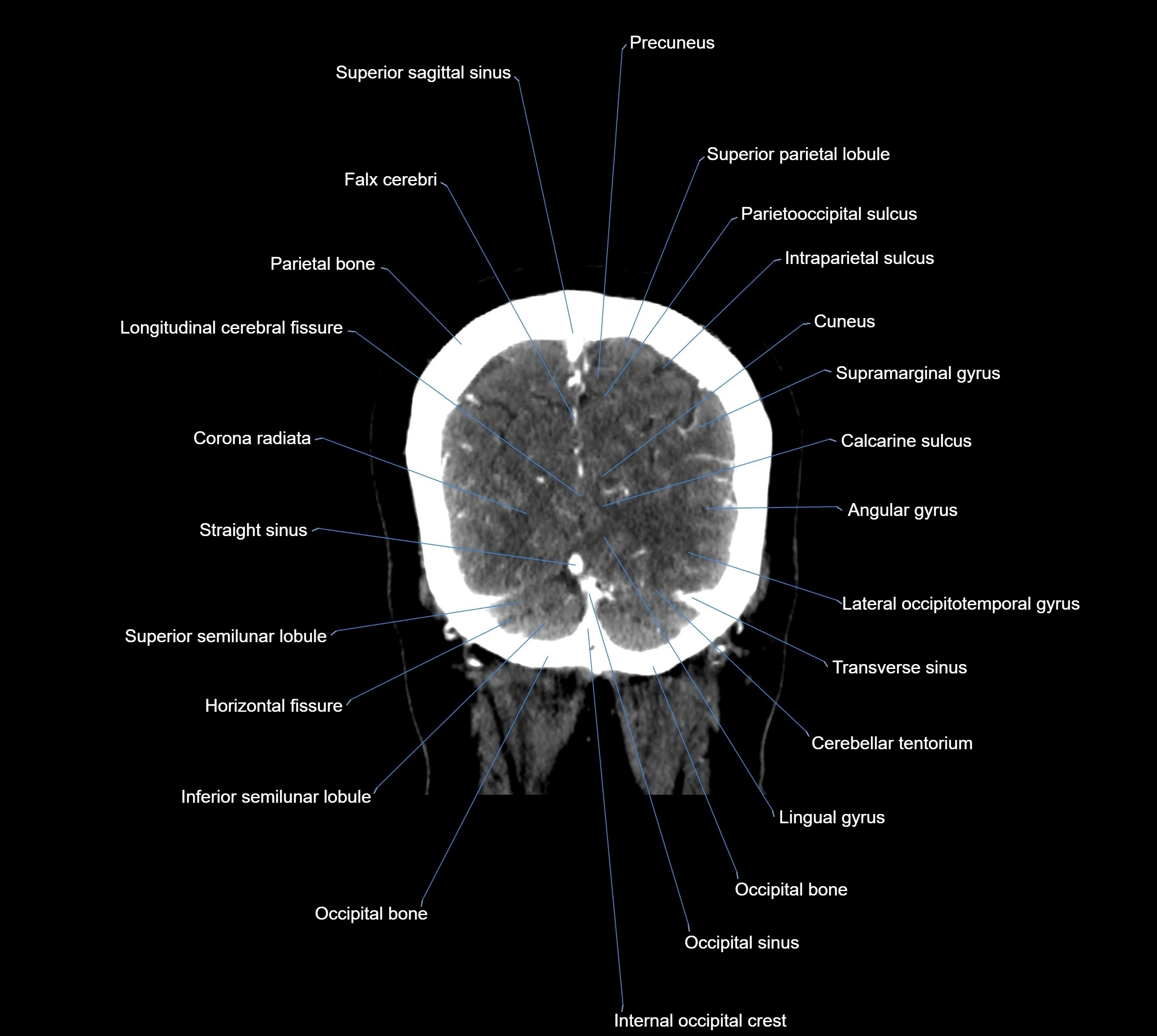CT Brain coronal cross sectional radiology anatomy image  -img-00001-040.webp